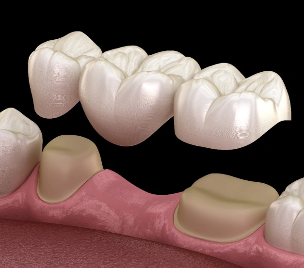 Dental bridge restoration showing artificial teeth replacing missing tooth in gum model.
