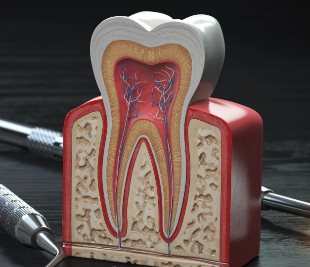 Dental model showing tooth cross-section with crown, pulp, and root canal anatomy.